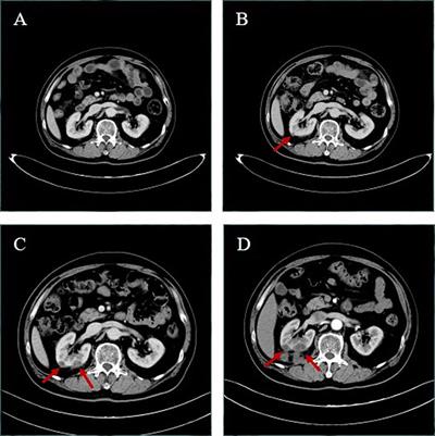 Renal Abscess Caused by Crizotinib: A Rare Case Report